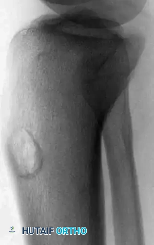 CMF Proximal Tibia Lateral