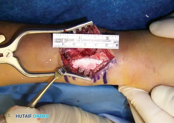 CMF Distal Radius Xray