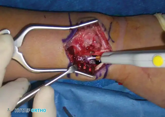 CMF Curettage and Argon Beam