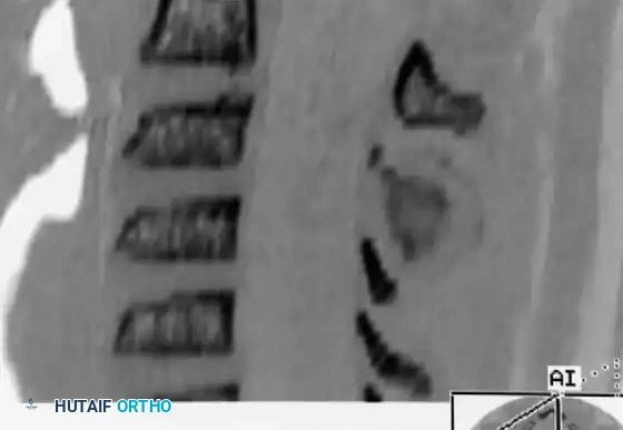 Osteoblastoma Cervical Spine CT Sagittal