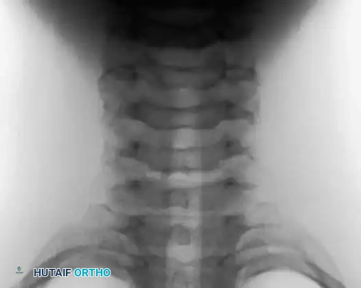 Osteoblastoma Cervical Spine AP