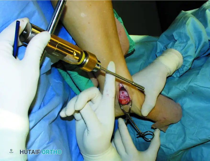 OSTEOCHONDRAL AUTOGRAFT/ ALLOGRAFT TRANSPLANTATION Surgical Diagram