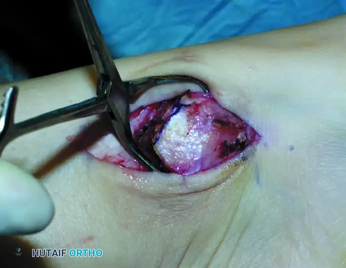 OSTEOCHONDRAL AUTOGRAFT/ ALLOGRAFT TRANSPLANTATION Surgical Diagram