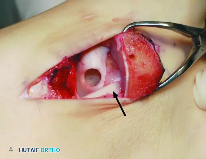 OSTEOCHONDRAL AUTOGRAFT/ ALLOGRAFT TRANSPLANTATION Surgical Diagram