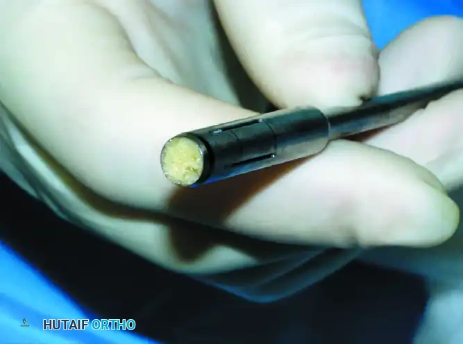 OSTEOCHONDRAL AUTOGRAFT/ ALLOGRAFT TRANSPLANTATION Surgical Diagram