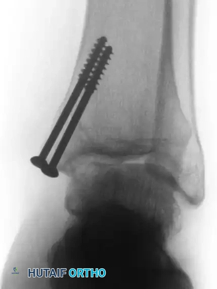 OSTEOCHONDRAL AUTOGRAFT/ ALLOGRAFT TRANSPLANTATION Surgical Diagram
