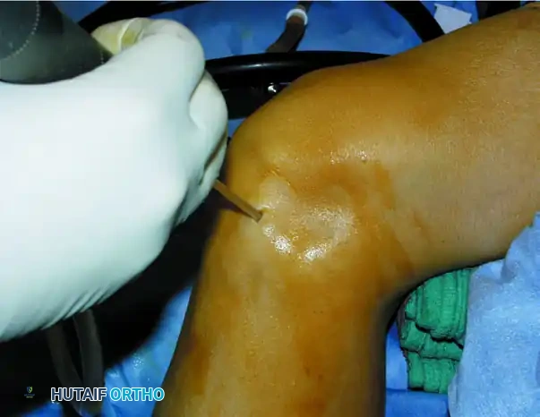 OSTEOCHONDRAL AUTOGRAFT/ ALLOGRAFT TRANSPLANTATION Surgical Diagram