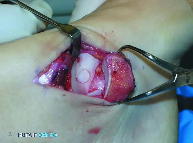 OSTEOCHONDRAL AUTOGRAFT/ ALLOGRAFT TRANSPLANTATION Surgical Diagram