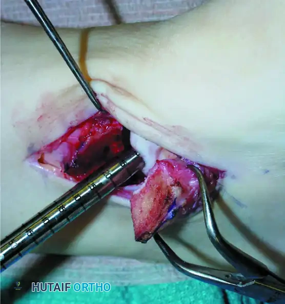 FIGURE 89-58 Positioning of patient for ankle arthroscopy.