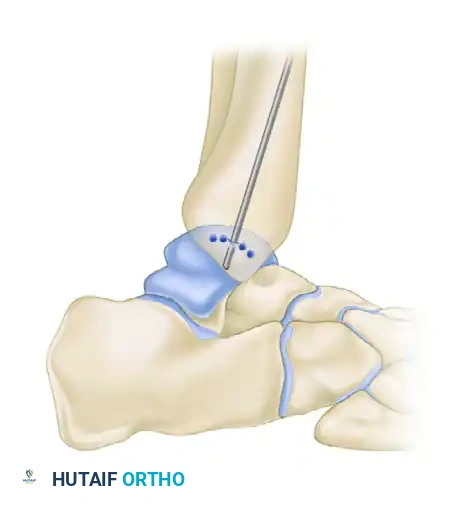 OSTEOCHONDRAL AUTOGRAFT/ ALLOGRAFT TRANSPLANTATION Surgical Diagram