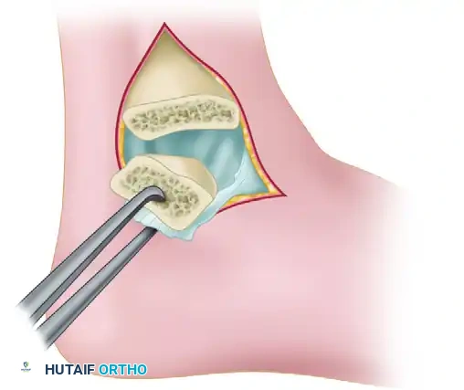 مخطط يوضح القطع العظمي للوصول إلى الإصابة