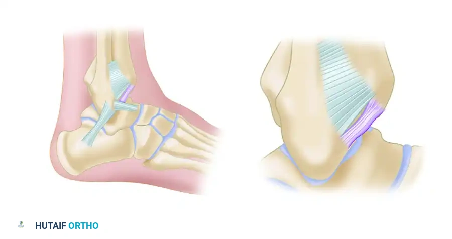 Osteochondral Ridges of the Talus and Tibia: Anterior and Posterior Impingement Syndromes