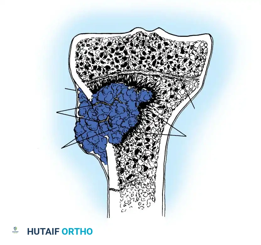 Illustration of osteomyelitis osteomyelitis osteomyelitis - Dr. Mohammed Hutaif