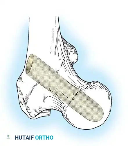 Core Decompression Tract