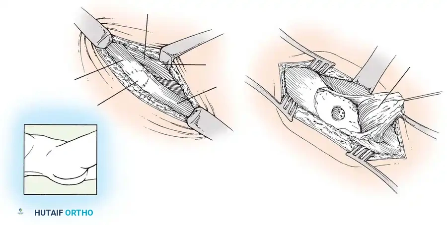 Trephine Fenestration