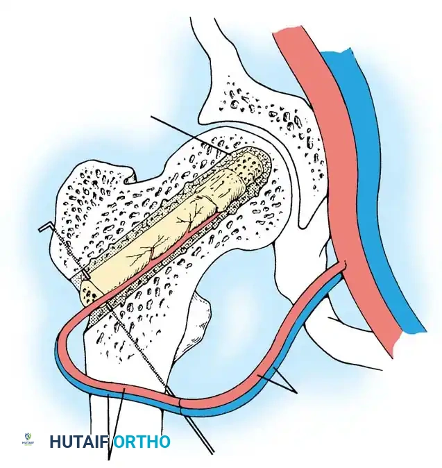 Vascularized Fibular Graft