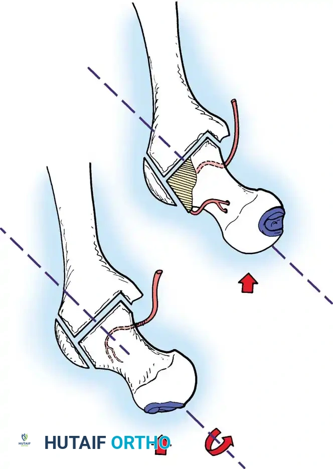 Rotational Osteotomy