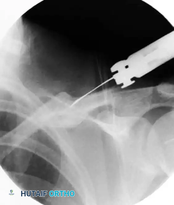 Fluoroscopic determination of osteotomy plane