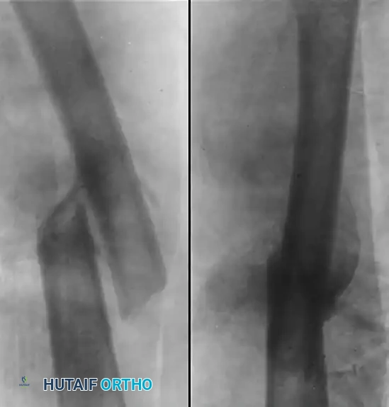 OSTEOTOMY FOR FEMORAL MALUNION Surgical Diagram