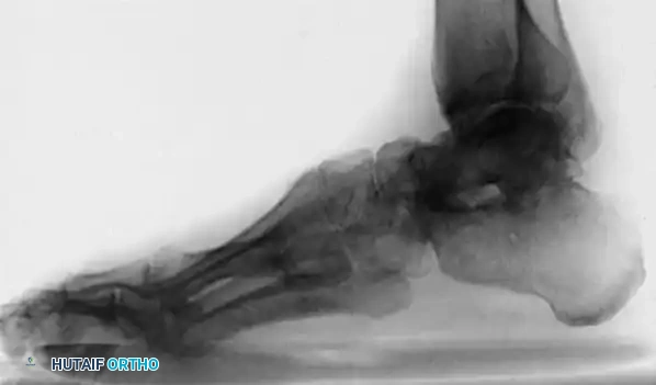OSTEOTOMY OF THE CALCANEUS Surgical Diagram