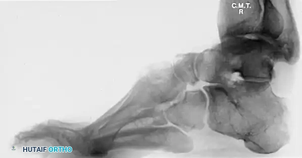 OSTEOTOMY OF THE CALCANEUS Surgical Diagram