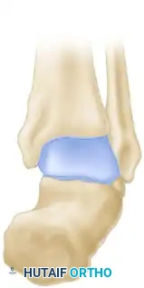 OSTEOTOMY OF THE CALCANEUS Surgical Diagram