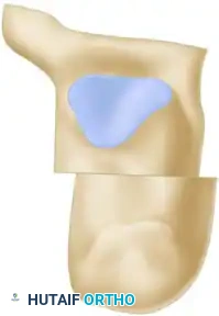 OSTEOTOMY OF THE CALCANEUS Surgical Diagram