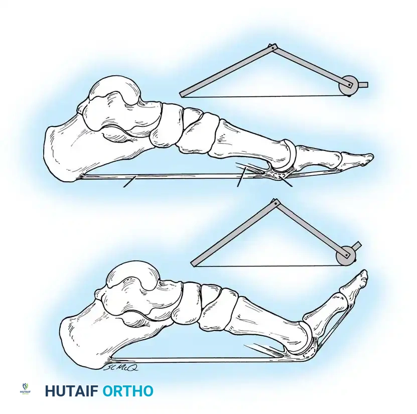 Plantar aponeurosis Flexor hallucis longus Sesamoid