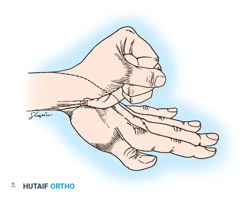 Operative Management of the Paralytic Hand: Principles and Tendon Transfers