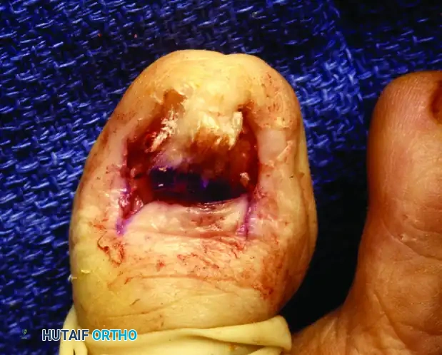 PARTIAL NAIL FOLD AND NAIL MATRIX REMOVAL Surgical Diagram