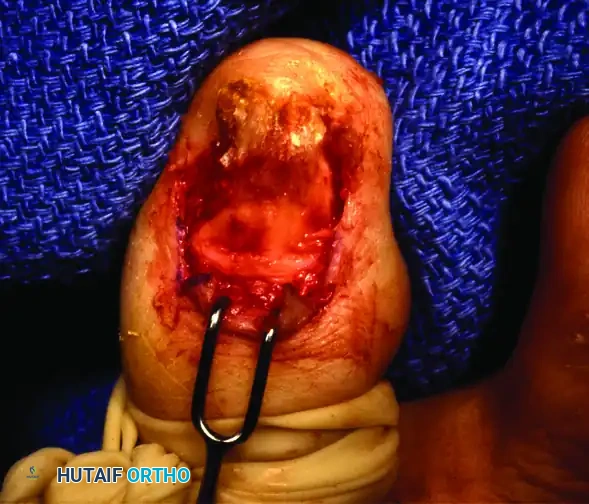 PARTIAL NAIL FOLD AND NAIL MATRIX REMOVAL Surgical Diagram