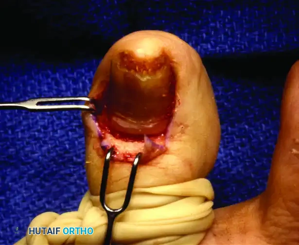 PARTIAL NAIL FOLD AND NAIL MATRIX REMOVAL Surgical Diagram