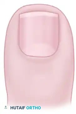 PARTIAL NAIL FOLD AND NAIL MATRIX REMOVAL Surgical Diagram