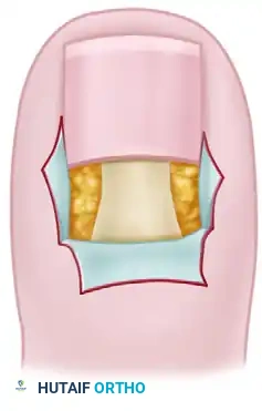 PARTIAL NAIL FOLD AND NAIL MATRIX REMOVAL Surgical Diagram
