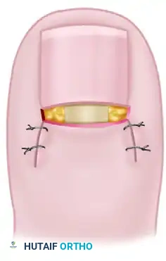 PARTIAL NAIL FOLD AND NAIL MATRIX REMOVAL Surgical Diagram