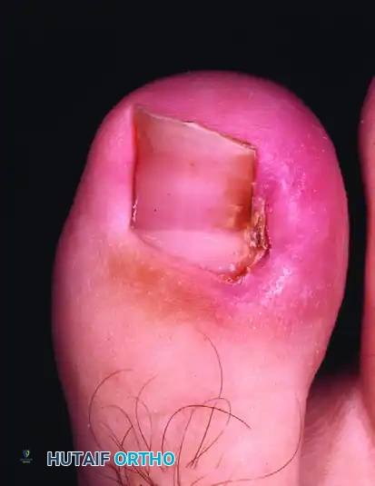 Partial Nail Fold and Nail Matrix Removal: Advanced Surgical Techniques