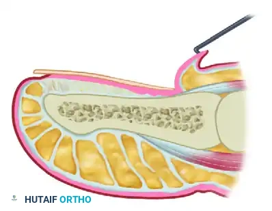 PARTIAL NAIL FOLD AND NAIL MATRIX REMOVAL Surgical Diagram