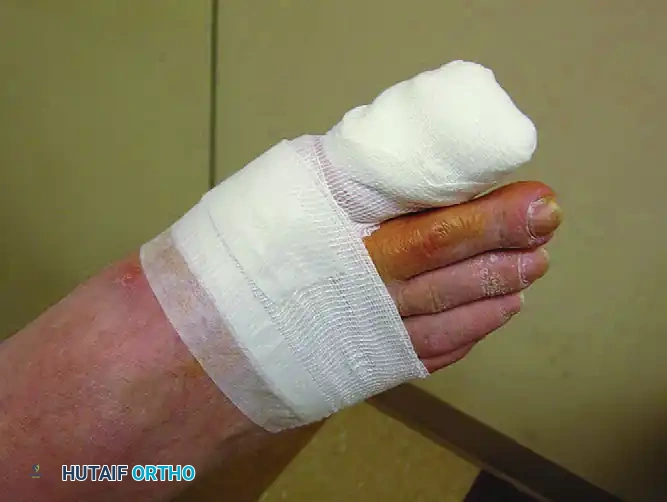 PARTIAL NAIL PLATE AND MATRIX REMOVAL Surgical Diagram