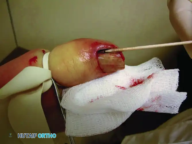 PARTIAL NAIL PLATE AND MATRIX REMOVAL Surgical Diagram