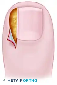 PARTIAL NAIL PLATE AND MATRIX REMOVAL Surgical Diagram