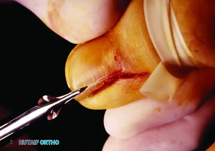 PARTIAL NAIL PLATE AND MATRIX REMOVAL Surgical Diagram