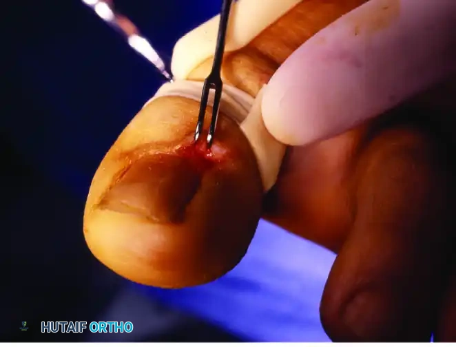 PARTIAL NAIL PLATE AND MATRIX REMOVAL Surgical Diagram