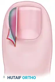 PARTIAL NAIL PLATE AND MATRIX REMOVAL Surgical Diagram