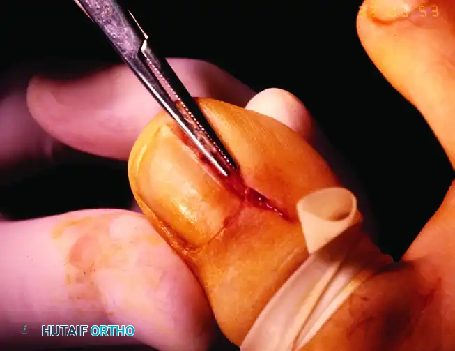 PARTIAL NAIL PLATE AND MATRIX REMOVAL Surgical Diagram