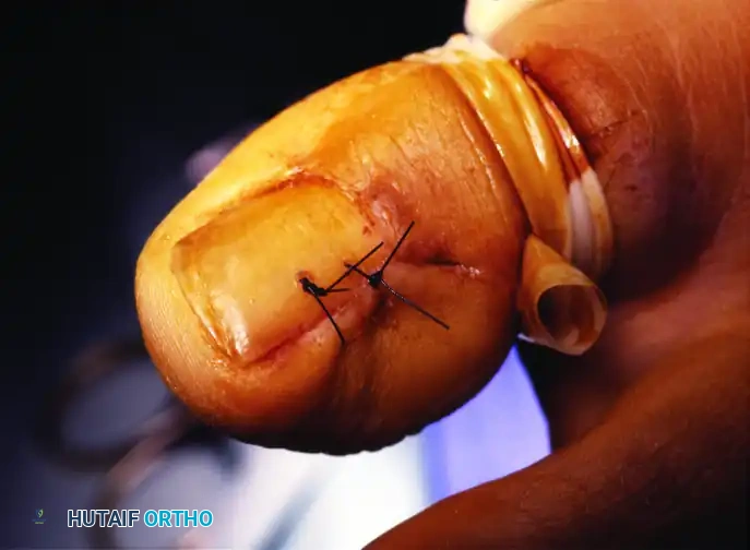 PARTIAL NAIL PLATE AND MATRIX REMOVAL Surgical Diagram