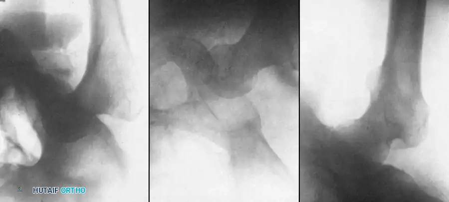 Fig. 58-3 A, Anteroposterior radiograph of left hip in 27-year-old man, illustrating posterior dislocation with myositis ossifi cans, now 37 days after injury. B, Same hip on fi fth day of traction. Head of femur is partially below acetabulum. C, Same hip on 17th day with reduced traction and extremity in abduction. (From Gupta RC, Shravat BP: Reduction of neglected traumatic dislocation of the hip by heavy traction, J Bone Joint Surg 59A:249, 1977.)