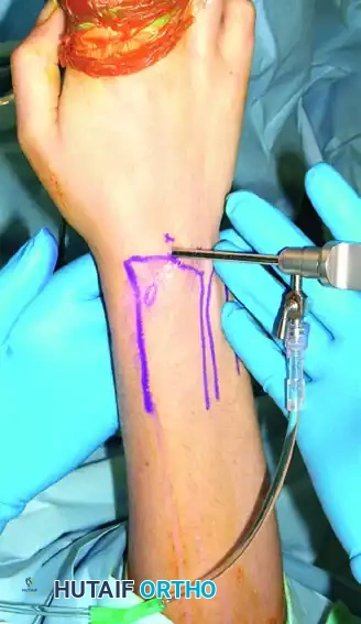 Blunt trocar is removed and arthroscope inserted.