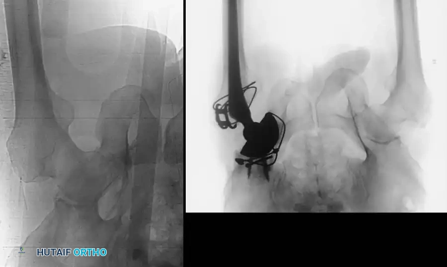 Pelvic Ring Fractures: Comprehensive Evaluation, Biomechanics, and Surgical Management