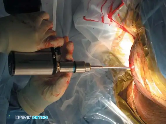 صورة توضيحية لـ الدليل الشامل لعلاج كسور الحوض