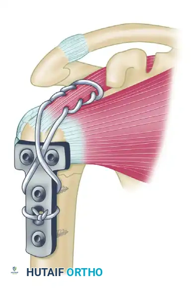 Supraspinatus